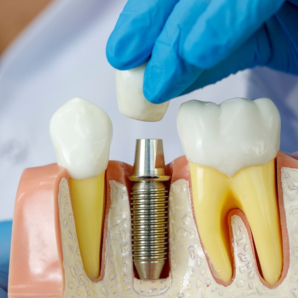 Dental Implants Edmonton