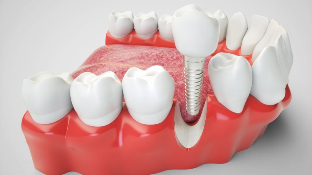 Dental Implants | Dentist in Edmonton