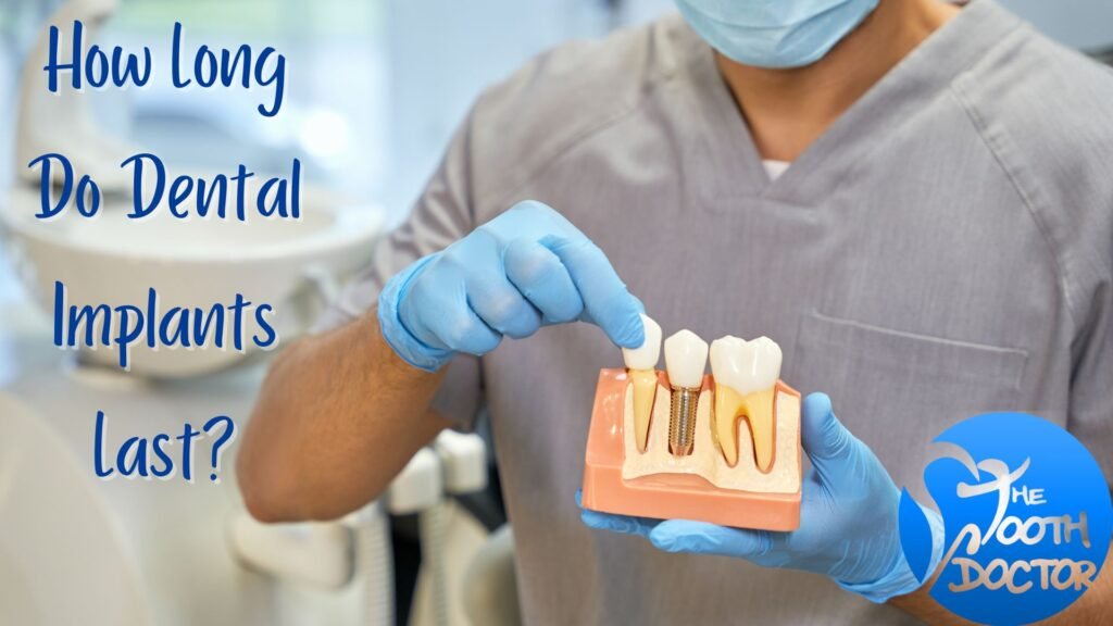 How Long Do Dental Implants Last? By The Tooth Doctor | Dentist in Edmonton