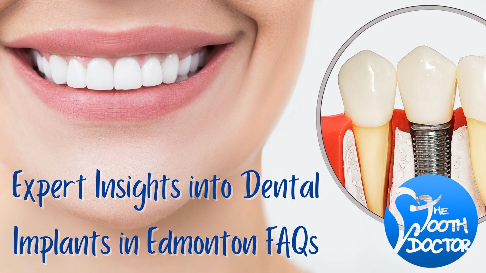 Expert Insights into Dental Implants in Edmonton FAQs