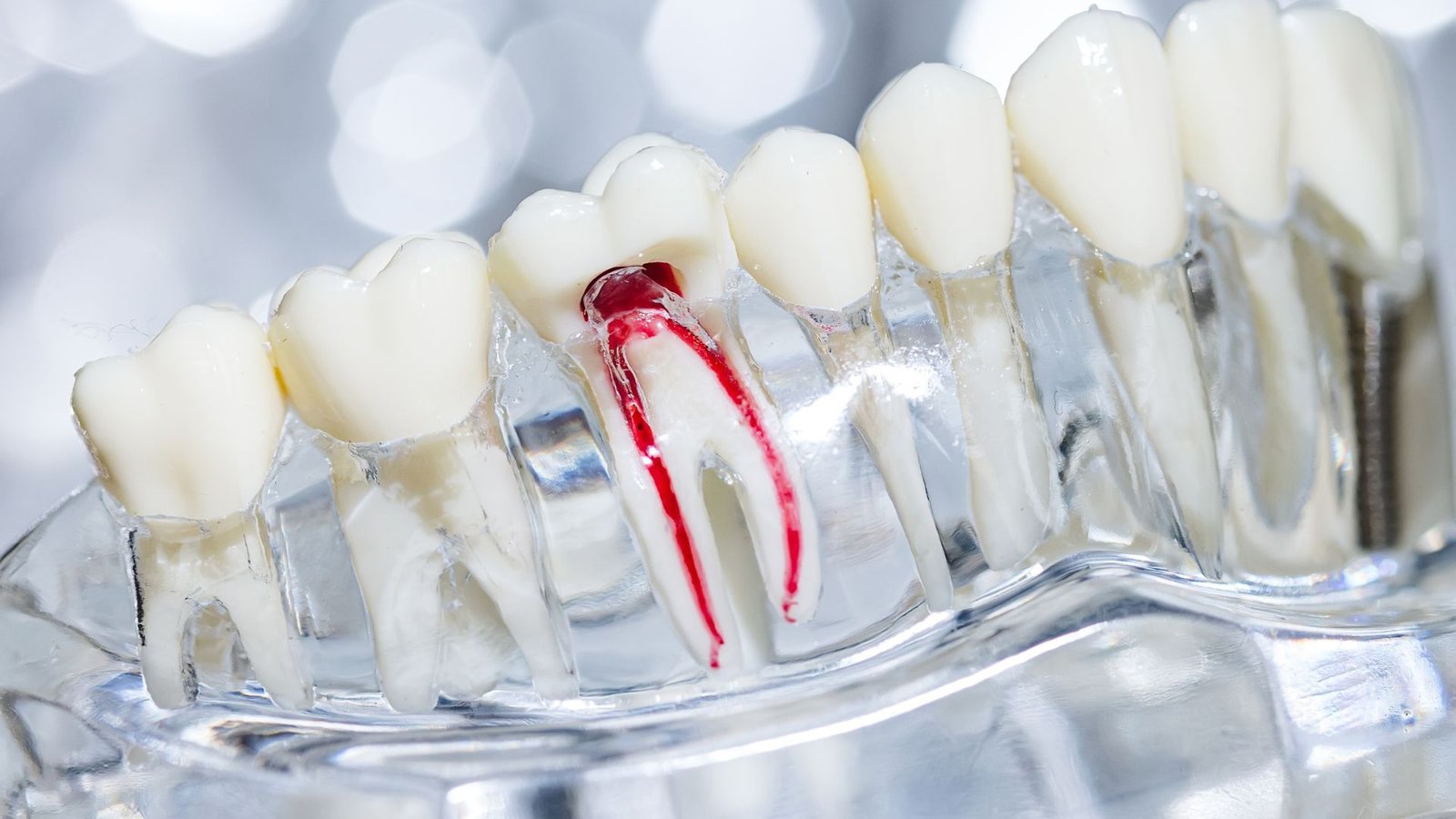 Root Canal Treatments in Edmonton dental clinic