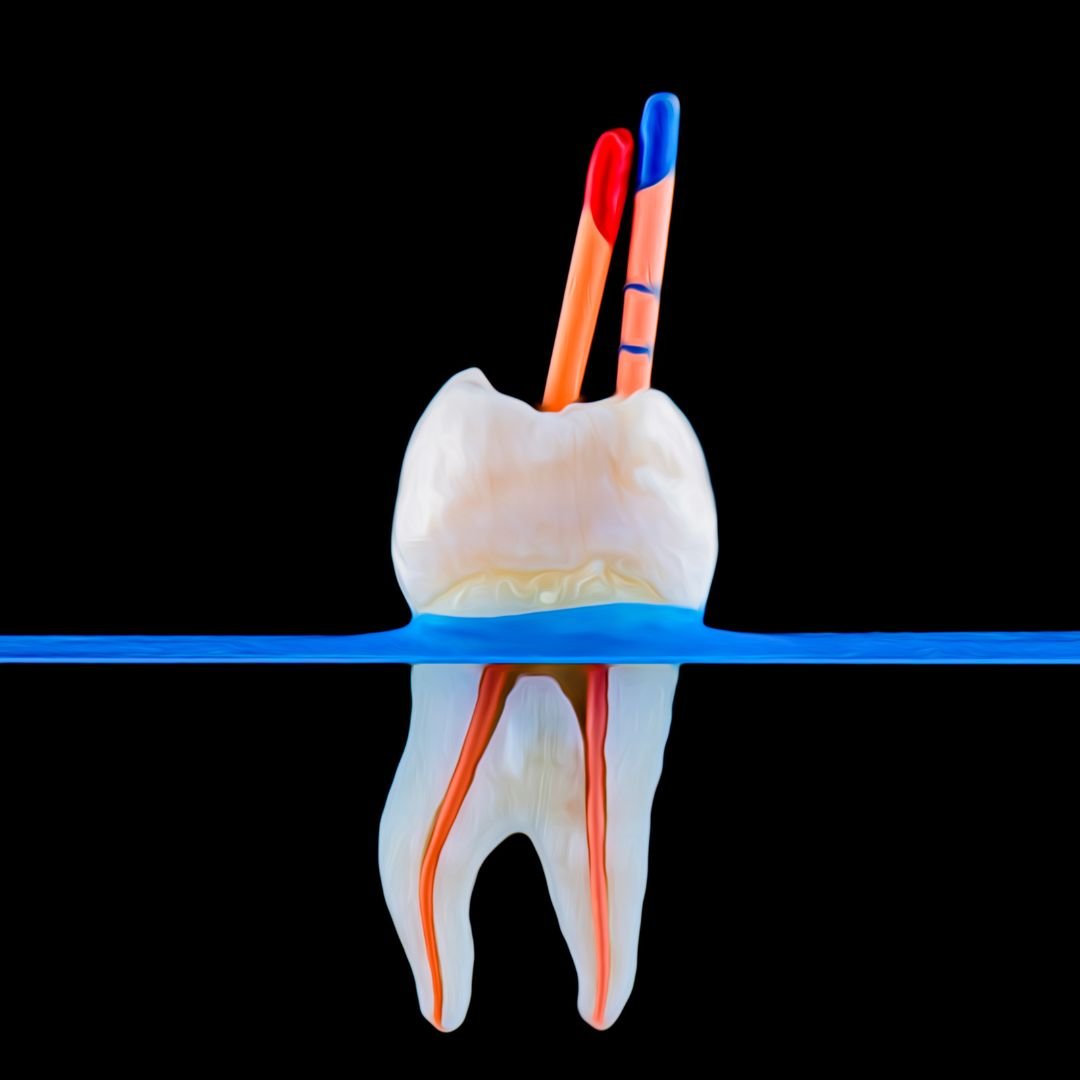 Root Canal Treatments Edmonton