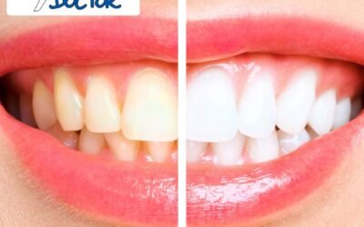 Professional Teeth Whitening in Edmonton: Brighten Your Smile with The Tooth Doctor